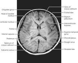 Normal Anatomy Radiology Key