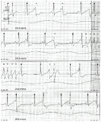 Por lo general es debida a una infección viral o bacteriana, y se presenta como dolor de pecho, signos repentinos de insuficiencia cardíaca y muerte súbita. Electrocardiograma Del Mes