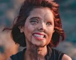 Inspiring story of acid attack survivor in India