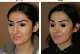 This sub is devoted to trans people to post pictures and solicit opinions about how they're succeeding at passing. Male To Female Transition Feminization Procedures Dr Turowski Plastic Surgery Chicago