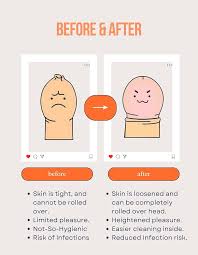 Image result for Phimosis