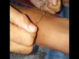 Ketuat adalah pertumbuhan yang tidak normal pada kulit yang disebabkan oleh papillomavirus. Cara Mudah Hilangkan Ketuat Youtube