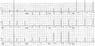 Los electrodos pueden sentirse fríos cuando se aplican por primera vez. Ecg Case 092 Litfl Ecg Top 100 Self Assessment Quiz