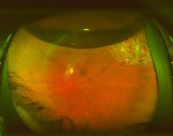 Dec 23, 2020 · retinal detachment, by helping your doctor repair any holes or tears in the retina; Floaters Retinal Tears And Retinal Detachments Visionaware