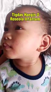 Pwede Ba Paliguan Ang May Tigdas Hangin