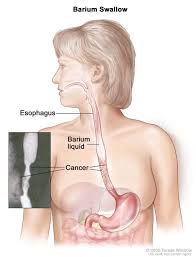 Three years ago, kate bowler was living her dream: How We Diagnose Esophageal Cancer Dana Farber Cancer Institute Boston Ma
