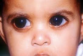 But blindness from glaucoma can often be prevented with early treatment. What Is Glaucoma Symptoms Treatment Definition