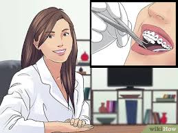 Plaque and braces don't mix. How To Brush Your Teeth With Braces On With Pictures Wikihow