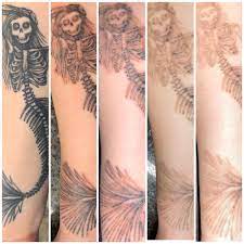 Tattoo Removal Process Pictures 4 Sessions Into The Process Tattooremoval