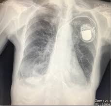 Image result for Cardiac Pacemaker Infection