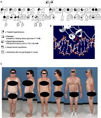 Image result for Lipodystrophy