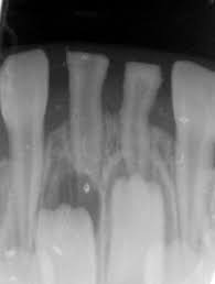 Image result for Neonatal Teeth