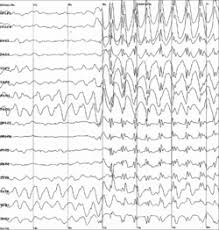 Image result for Status Epilepticus