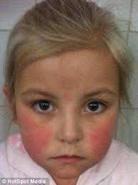 Girl with urticaria struggles to breathe and breaks out in hives in cold  weather