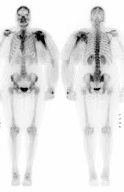 Image result for Osteomyelitis Bone Scan