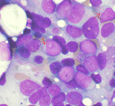 Image result for Acute Leukemia