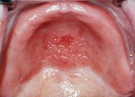 Image result for Physical injury red spots roof of mouth