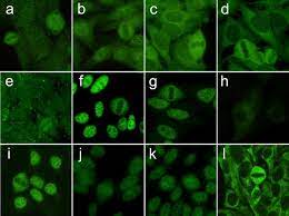Cidp is a chronic acquired disorder, which usually presents as a progressive or relapsing sensory and motor, proximal and distal neuropathy with generalized areflexia, developing over at least 8 weeks; Iif On Hep 2 Ana Slides Of Myositis Specific Autoantibodies From Download Scientific Diagram