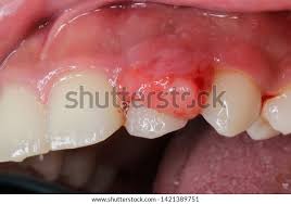 Image result for granuloma gum disease