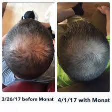 With a few simple remedies and proper scalp care, the healthy properties of sebum can be fully enjoyed. How To Regrow Hair That Has Closed Pores Quora