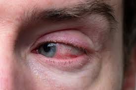 Image result for Dry Eye