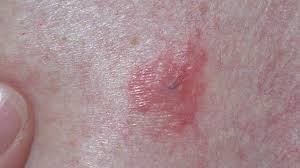 For many people, the only sign of this skin cancer is a spot that. Pictures Of Melanoma Skin Changes To Look For And More