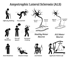 Amyotrophic lateral sclerosis (als) is a rare neurological disease that primarily affects the nerve cells (neurons) responsible for controlling voluntary muscle. Amyotrophic Lateral Sclerosis Als Disease Signs And Symptoms Stock Vector Illustration Of Hydraulic Difficulty 139283327