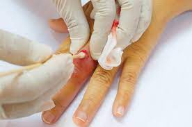 Abscess Incision & Drainage Raleigh & Wake Forest - Heritage Urgent &  Primary Care