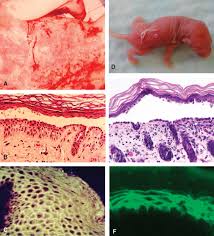 Pemphigus foliaceus is an autoimmune skin disease that typically begins in middle age dogs. Pemphigus Vulgaris An Overview Sciencedirect Topics