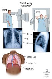 Image result for lung cancer xray