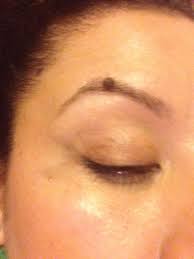 The procedure typically takes less than a minute, and is fairly painless. Will I Still Have Hair On My Eyebrow If I Remove A Mole I Have Right On My Eyebrow Photo