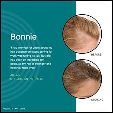 Could it be female pattern hair loss? Hair Loss Thinning Supplement Women Hair Vitamin Best Luxclout Com