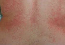 Not All Rashes Are Bull S Eye Mine Looks Like This Acute Brucellosis With Thrombocytopenia Maculopapular Rash This P Lyme Disease Lyme Fibromyalgia Rash