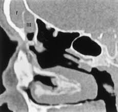 They are extramuralethmoidal air cells that extend into the inferomedial orbitalfloor and are present in ~20. Frontal Recess Air Cells Spectrum Of Ct Appearances Coates 2003 Australasian Radiology Wiley Online Library