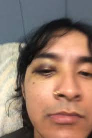 Rocky Balboa Black Eye How to