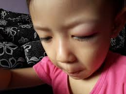 Lingkaran hitam di bawah mata bisa mengganggu penampilan. Bila Mata Anak Ketumbit Azlinda Alin Malaysian Parenting Lifestyle Beauty Blogs