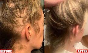 An imbalance of the hormones caused by lack of iodine would cause hair loss, dry skin, hoarse voice, muscle cramps and a myriad of. New Mum Reveals How She Got Rid Of Post Partum Hair Loss Newsburrow