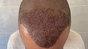 That stated, there are two types of hair transplant procedures. How Long After Hair Transplant For Grafts To Become Secure