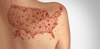 US Measles Cases Hit 30-Year High