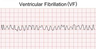 Image result for Ventricular Fibrillation Management in the Adult