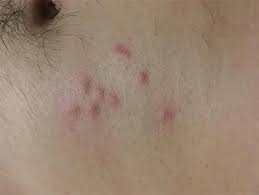 Image result for scabies bite