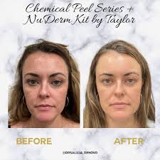 Another amazing acne scar transformation with microneedling + exosomes! 😍  Exosomes are tiny vesicles that facilitate cell communication and repair.  When applied with microneedling, they deliver growth factors and proteins  that enhance