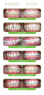 Dr Darian Hampton A Clearcorrect North Dallas Clear Braces Provider Also Offers Veneers Dental Implants In Farmers Bra Invisalign Dentistry Getting Braces