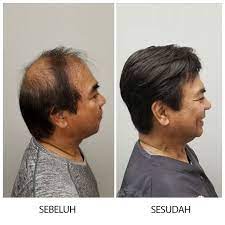 Check spelling or type a new query. Botak Sudah Bukan Masalah Lagi Bagi Pria Ada Obatnya
