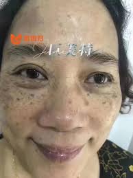 曼悅伶巨美特獨家真皮斑技術一次手工技術一個套餐一步到位，祛斑又逆齡終身受益WeChat : IsabelWong3