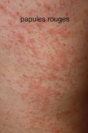Check spelling or type a new query. Dermato Info Eruption Polymorphe De La Grossesse