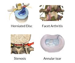 Image result for Low Back Imaging