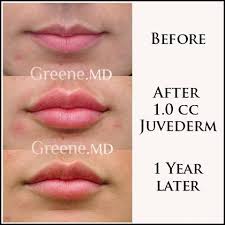 Long Lasting Lip Filler Results By Dr Ryan Greene Facial Fillers Lip Augmentation Lasting Lips