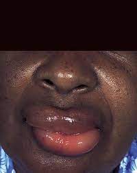 Inchaco Dos Labios E Da Lingua Disturbios Da Boca E Dos Dentes Manual Msd Versao Saude Para A Familia