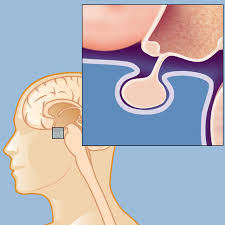 Image result for Acromegaly